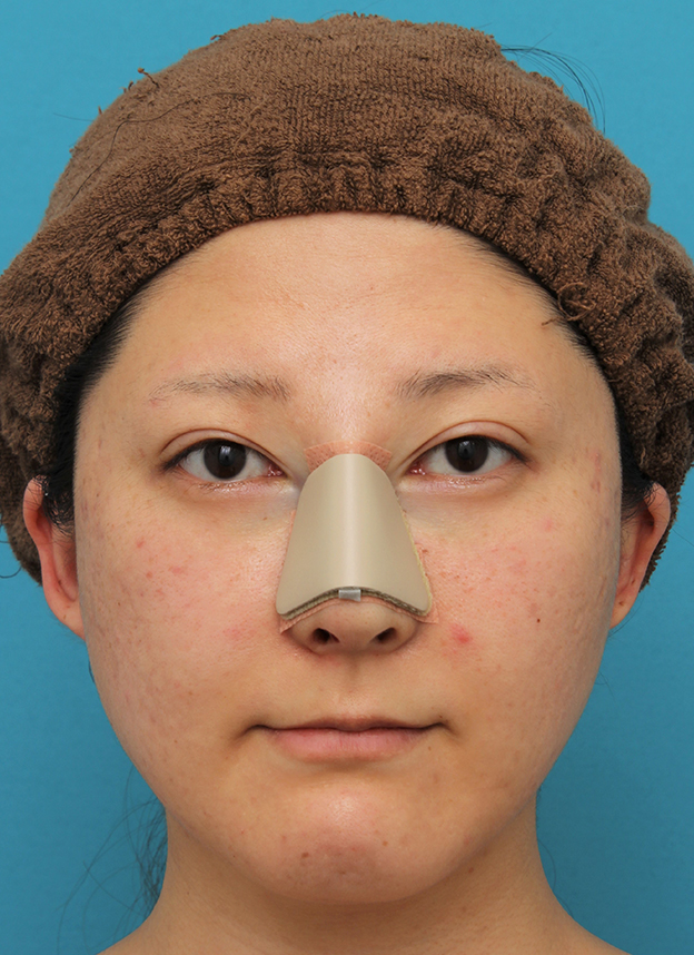 わし鼻・段鼻修正,ハンプ切除,ハンプ切除+鼻骨切り幅寄せでワシ鼻を真っ直ぐにし、鼻筋を通した症例写真,手術直後,mainpic_hump012b.jpg