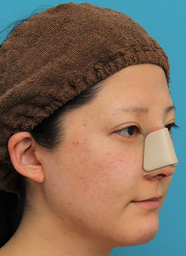わし鼻・段鼻修正,ハンプ切除,ハンプ切除+鼻骨切り幅寄せでワシ鼻を真っ直ぐにし、鼻筋を通した症例写真,手術直後,mainpic_hump012i.jpg
