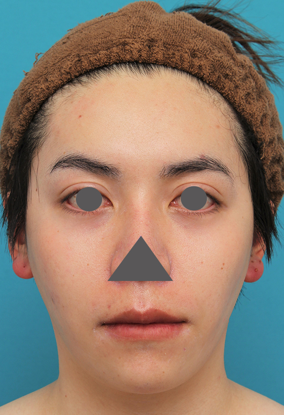 唇を薄く（口唇縮小術）,上下の厚い唇を手術で薄くした男性の症例写真,After（6ヶ月後）,ba_usuku013_b01.jpg