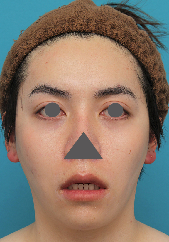 症例写真,上下の厚い唇を手術で薄くした男性の症例写真,After（6ヶ月後）,ba_usuku013_b02.jpg