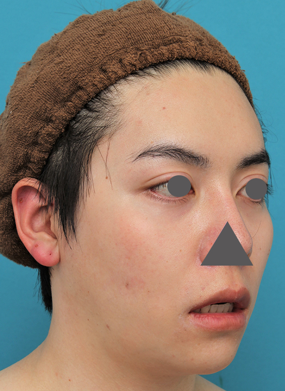 唇を薄く（口唇縮小術）,上下の厚い唇を手術で薄くした男性の症例写真,After（6ヶ月後）,ba_usuku013_b04.jpg