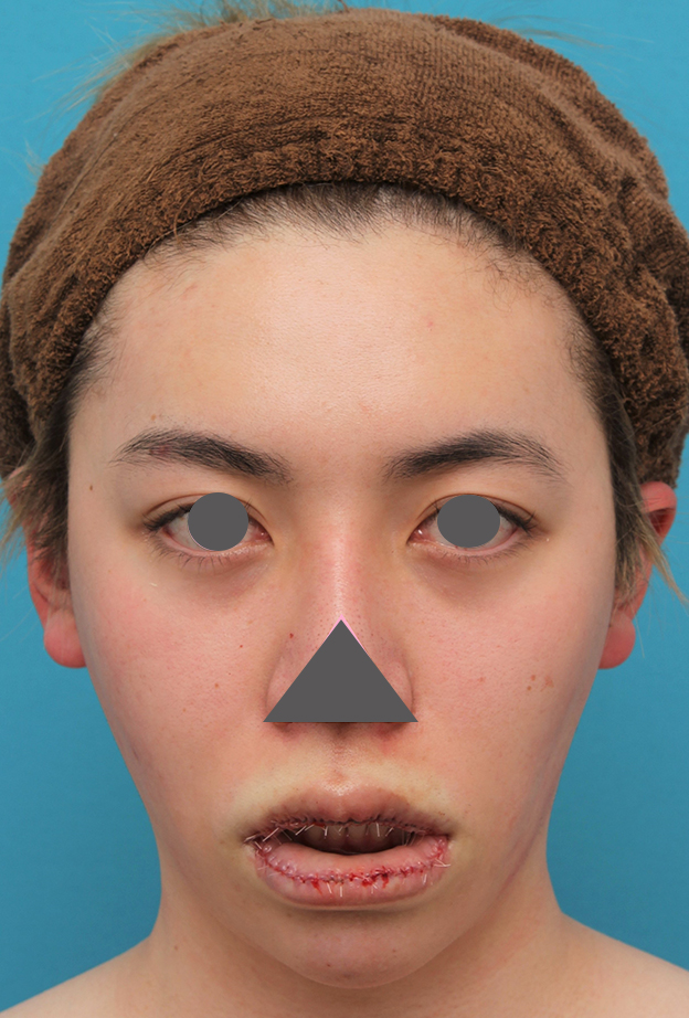 唇を薄く（口唇縮小術）,上下の厚い唇を手術で薄くした男性の症例写真,手術直後,mainpic_usuku013c.jpg