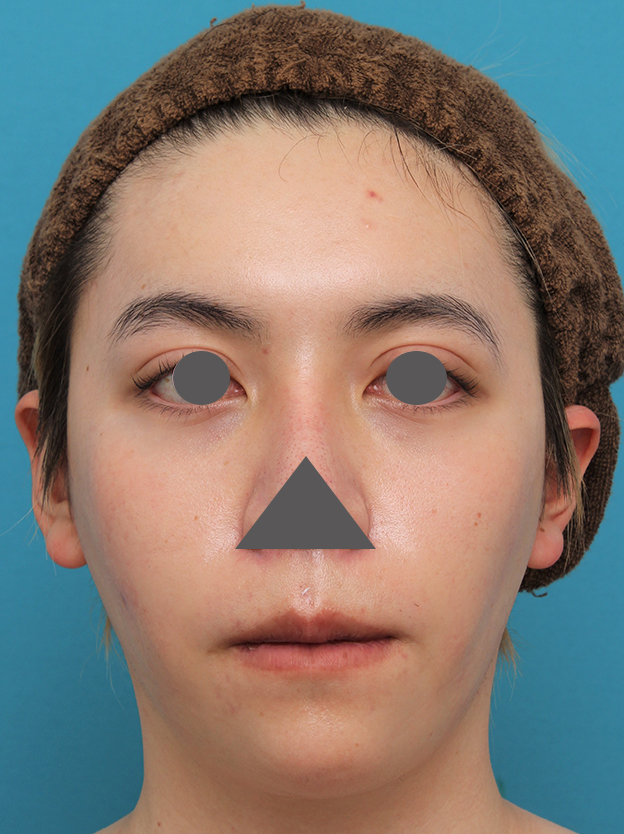 唇を薄く（口唇縮小術）,上下の厚い唇を手術で薄くした男性の症例写真,3週間後,口を閉じた状態,mainpic_usuku013h.jpg