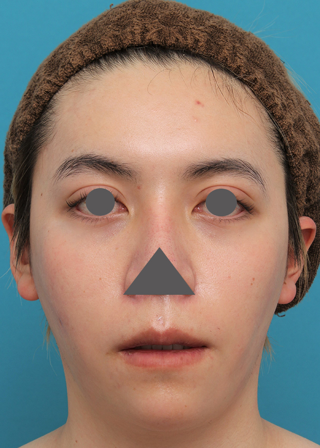 症例写真,上下の厚い唇を手術で薄くした男性の症例写真,3週間後,口を開けた状態,mainpic_usuku013i.jpg