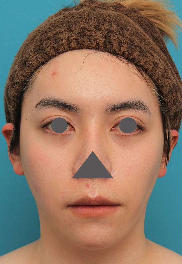 唇を薄く（口唇縮小術）,上下の厚い唇を手術で薄くした男性の症例写真,2ヶ月後,口を閉じた状態,mainpic_usuku013j.jpg