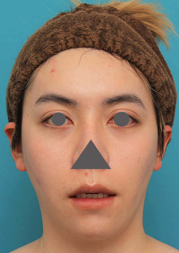 唇を薄く（口唇縮小術）,上下の厚い唇を手術で薄くした男性の症例写真,2ヶ月後,口を開けた状態,mainpic_usuku013k.jpg