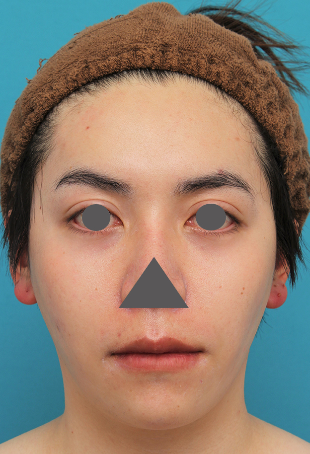 唇を薄く（口唇縮小術）,上下の厚い唇を手術で薄くした男性の症例写真,6ヶ月後,口を閉じた状態,mainpic_usuku013l.jpg