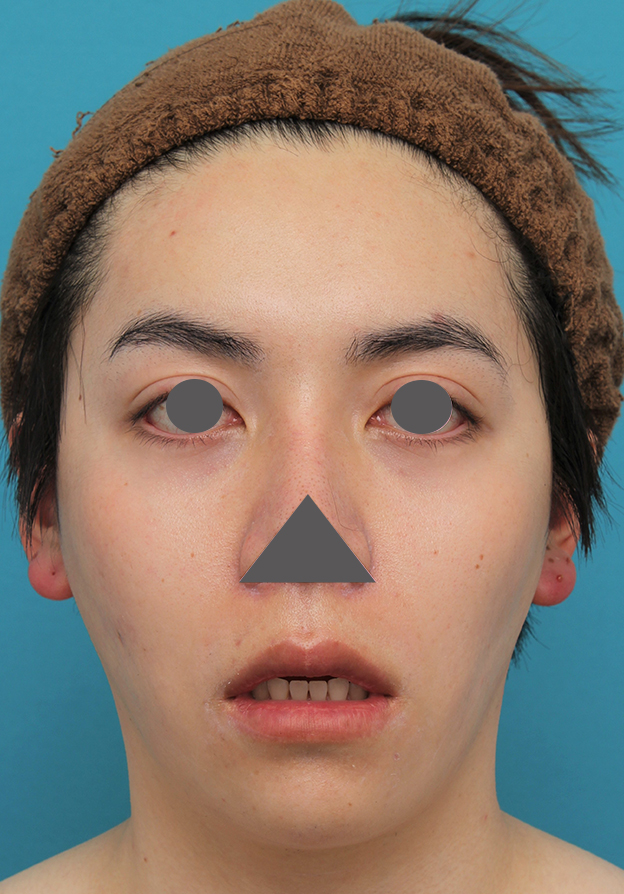 症例写真,上下の厚い唇を手術で薄くした男性の症例写真,6ヶ月後,口を開けた状態,mainpic_usuku013m.jpg