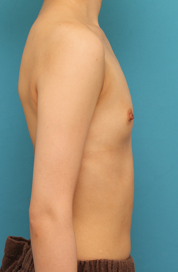 豊胸手術（シリコンプロテーゼ）,ほぼ平らな胸の20代女性にシリコンプロテーゼ豊胸手術を行った症例写真,Before,ba_hokyo033_b04.jpg