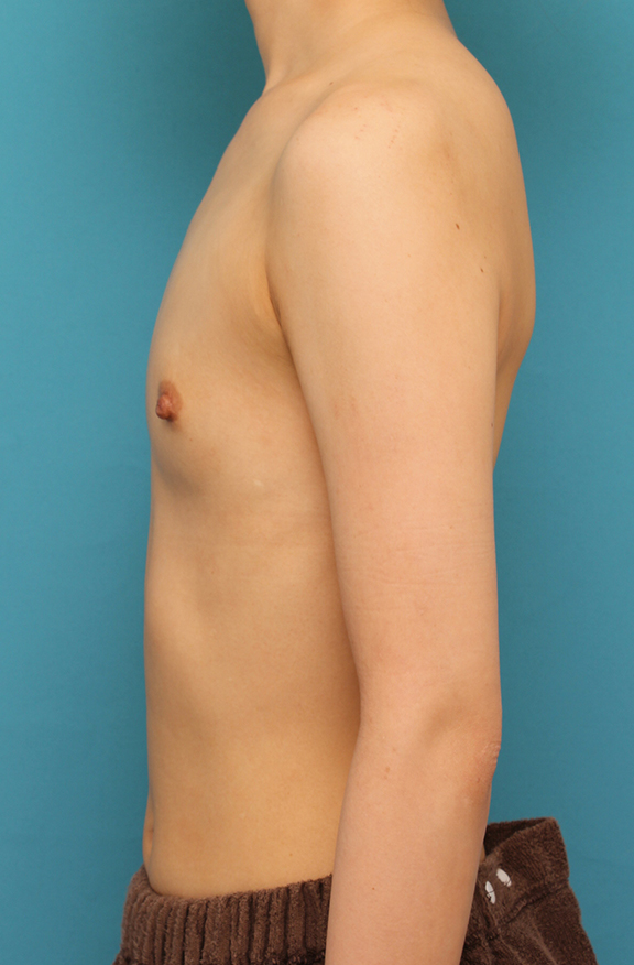 豊胸手術（シリコンプロテーゼ）,ほぼ平らな胸の20代女性にシリコンプロテーゼ豊胸手術を行った症例写真,Before,ba_hokyo033_b05.jpg