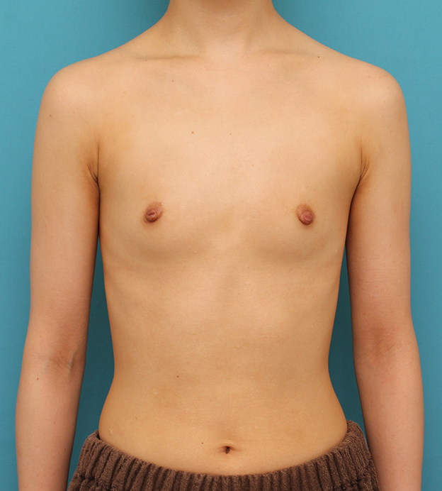 豊胸手術（シリコンプロテーゼ）,ほぼ平らな胸の20代女性にシリコンプロテーゼ豊胸手術を行った症例写真,手術前,mainpic_hokyo033a.jpg