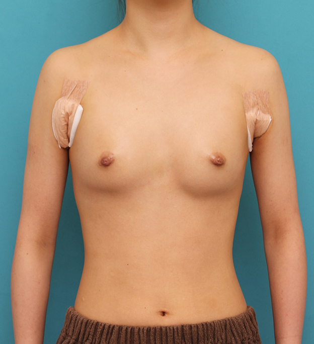 豊胸手術（シリコンプロテーゼ）,ほぼ平らな胸の20代女性にシリコンプロテーゼ豊胸手術を行った症例写真,手術直後,mainpic_hokyo033b.jpg