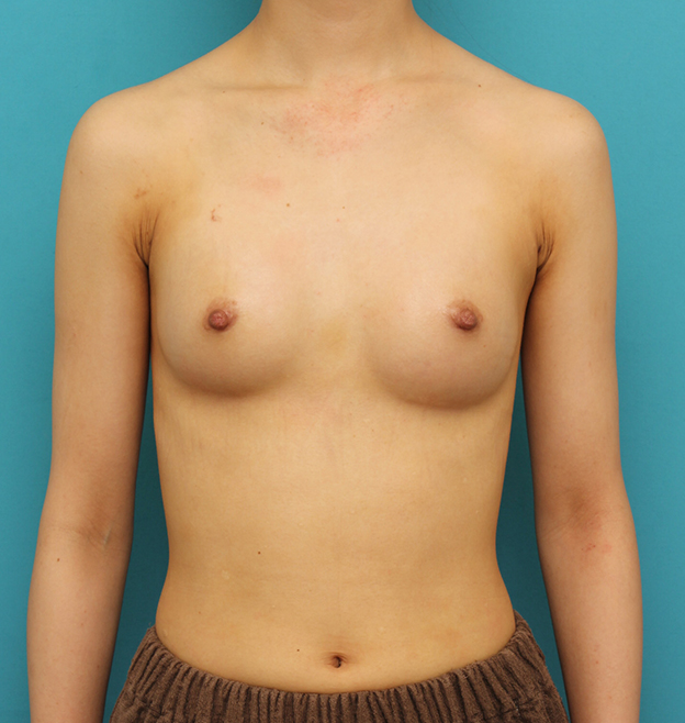 豊胸手術（シリコンプロテーゼ）,ほぼ平らな胸の20代女性にシリコンプロテーゼ豊胸手術を行った症例写真,1週間後,mainpic_hokyo033c.jpg