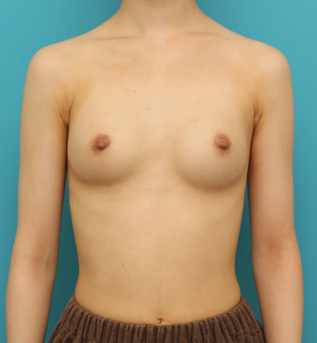 豊胸手術（シリコンプロテーゼ）,ほぼ平らな胸の20代女性にシリコンプロテーゼ豊胸手術を行った症例写真,3週間後,mainpic_hokyo033d.jpg