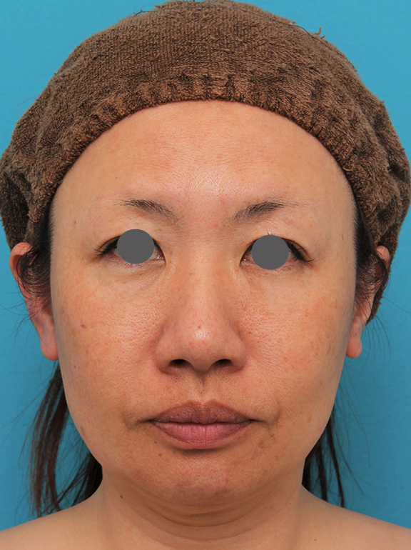 イタリアンリフトで頬のたるみをリフトアップした40代女性の症例写真,After（6ヶ月後）,ba_italian027_a01.jpg
