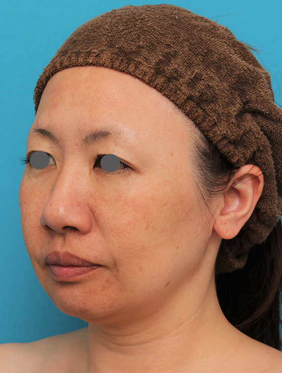 イタリアンリフト,イタリアンリフトで頬のたるみをリフトアップした40代女性の症例写真,After（6ヶ月後）,ba_italian027_b02.jpg