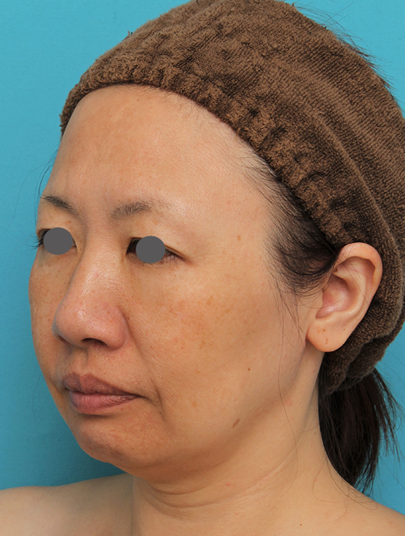 イタリアンリフト,イタリアンリフトで頬のたるみをリフトアップした40代女性の症例写真,Before,ba_italian027_b02.jpg