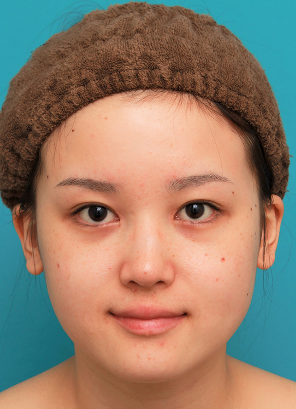 小顔専用脂肪溶解注射メソシェイプフェイス,顔専用脂肪溶解注射とエラボツリヌストキシンで小顔になった20代女性の症例写真,Before,ba_meso_face015_b01.jpg
