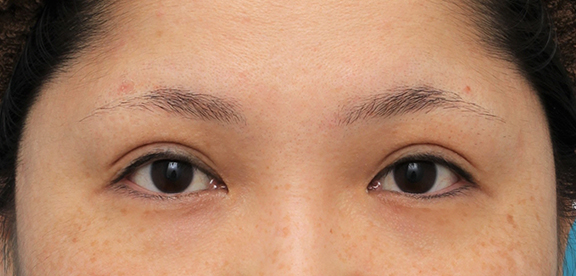二重まぶた・全切開法,他院での眼瞼下垂手術後に二重まぶた全切開法で幅を広げる修正手術をした症例写真,After（6ヶ月後）,ba_eye_modify023_b01.jpg