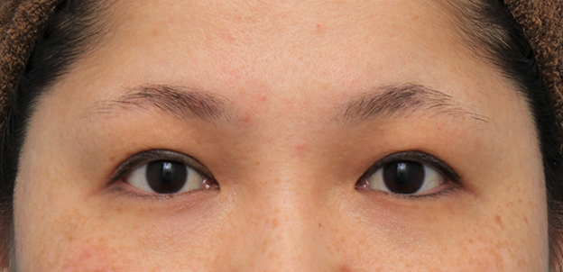 他院で受けた手術の修正（二重まぶた・目もと）,他院での眼瞼下垂手術後に二重まぶた全切開法で幅を広げる修正手術をした症例写真,修正手術前,mainpic_eye_modify023a.jpg