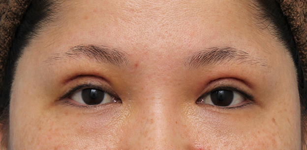 二重まぶた・全切開法,他院での眼瞼下垂手術後に二重まぶた全切開法で幅を広げる修正手術をした症例写真,6日後,mainpic_eye_modify023c.jpg
