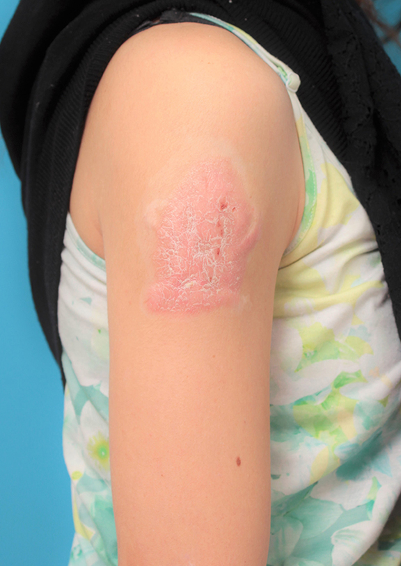 刺青（タトゥー）除去,若い女性の肩の大きな入れ墨を剥削手術で除去した症例写真,After（5年8ヶ月後）,ba_irezumi035_b01.jpg