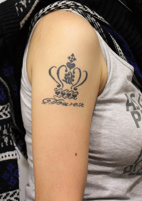 刺青（タトゥー）除去,若い女性の肩の大きな入れ墨を剥削手術で除去した症例写真,Before,ba_irezumi035_b01.jpg