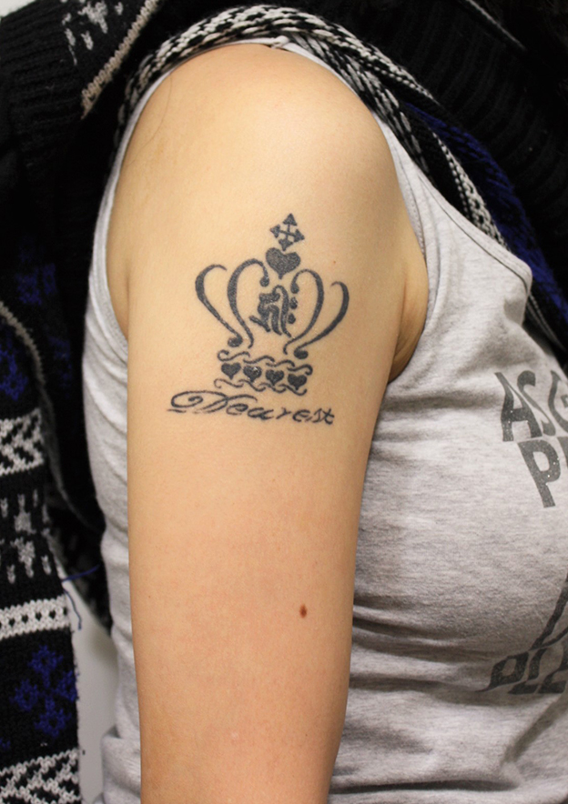 刺青（タトゥー）除去,若い女性の肩の大きな入れ墨を剥削手術で除去した症例写真,治療前,mainpic_irezumi035a.jpg