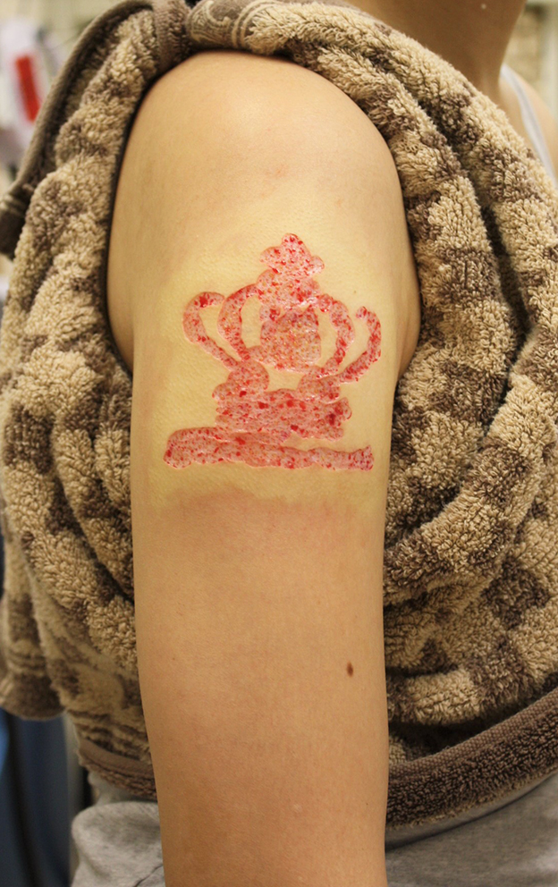 刺青（タトゥー）除去,若い女性の肩の大きな入れ墨を剥削手術で除去した症例写真,手術直後,mainpic_irezumi035b.jpg
