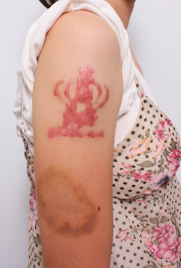 症例写真,若い女性の肩の大きな入れ墨を剥削手術で除去した症例写真,3ヶ月後,mainpic_irezumi035d.jpg