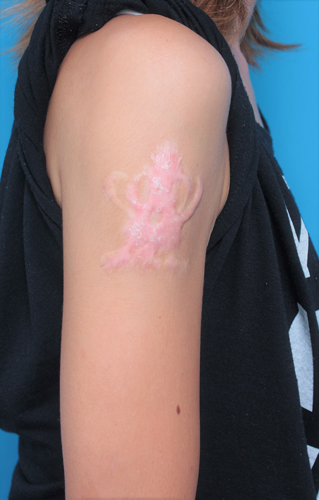 刺青（タトゥー）除去,若い女性の肩の大きな入れ墨を剥削手術で除去した症例写真,1年後,mainpic_irezumi035e.jpg