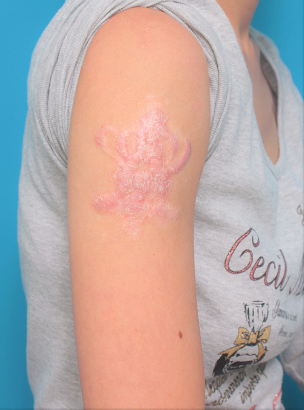 刺青（タトゥー）除去,若い女性の肩の大きな入れ墨を剥削手術で除去した症例写真,2年後,mainpic_irezumi035f.jpg