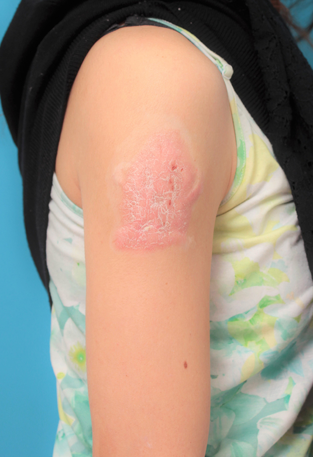 刺青（タトゥー）除去,若い女性の肩の大きな入れ墨を剥削手術で除去した症例写真,5年8ヶ月後,mainpic_irezumi035g.jpg