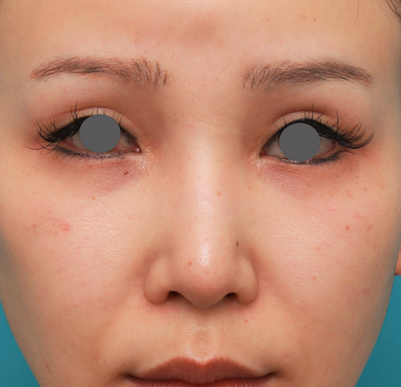症例写真,鼻のシリコンプロテーゼ+鼻先の耳介軟骨移植+小鼻縮小を同時に行った症例写真,After（6ヶ月後）,ba_ryubi1055_b01.jpg