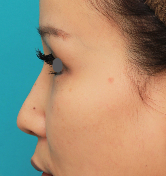 隆鼻術（シリコンプロテーゼ）,鼻のシリコンプロテーゼ+鼻先の耳介軟骨移植+小鼻縮小を同時に行った症例写真,After（6ヶ月後）,ba_ryubi1055_b03.jpg