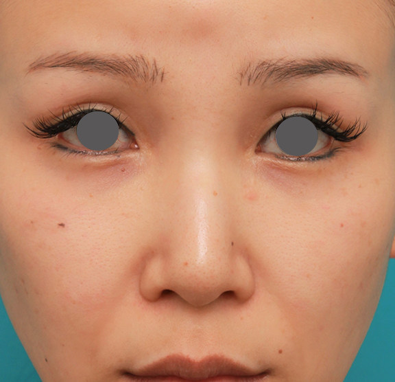 隆鼻術（シリコンプロテーゼ）,鼻のシリコンプロテーゼ+鼻先の耳介軟骨移植+小鼻縮小を同時に行った症例写真,Before,ba_ryubi1055_b01.jpg