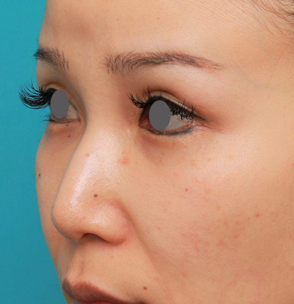 鼻翼縮小（小鼻縮小）,鼻のシリコンプロテーゼ+鼻先の耳介軟骨移植+小鼻縮小を同時に行った症例写真,Before,ba_ryubi1055_b02.jpg