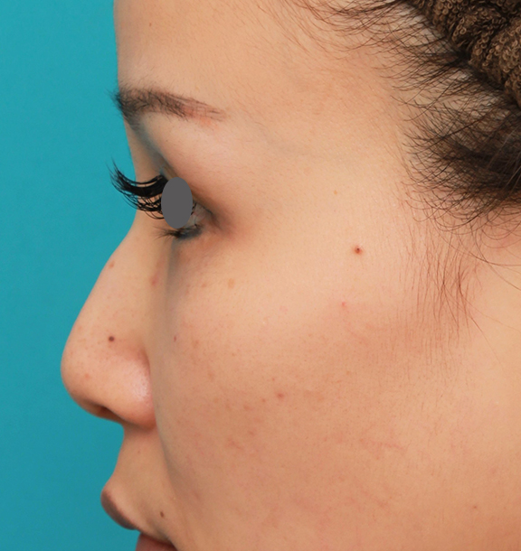 隆鼻術（シリコンプロテーゼ）,鼻のシリコンプロテーゼ+鼻先の耳介軟骨移植+小鼻縮小を同時に行った症例写真,Before,ba_ryubi1055_b03.jpg