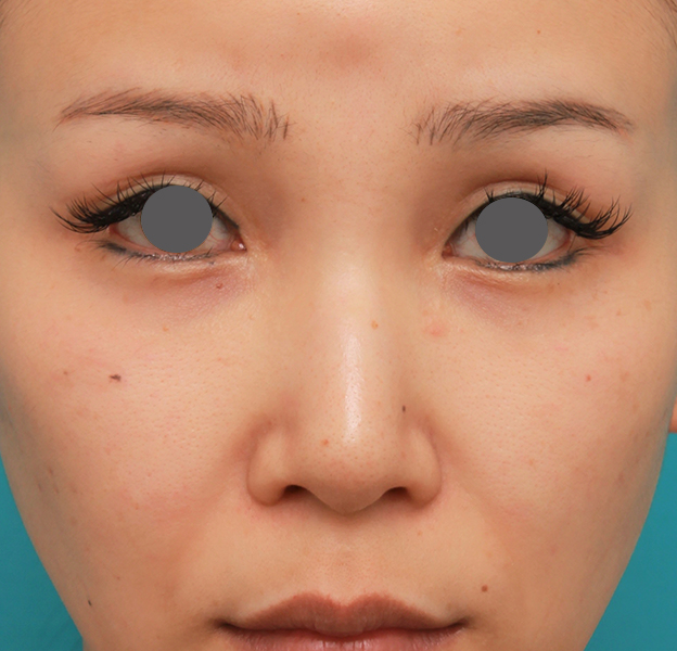 隆鼻術（シリコンプロテーゼ）,鼻のシリコンプロテーゼ+鼻先の耳介軟骨移植+小鼻縮小を同時に行った症例写真,手術前,mainpic_ryubi1055a.jpg