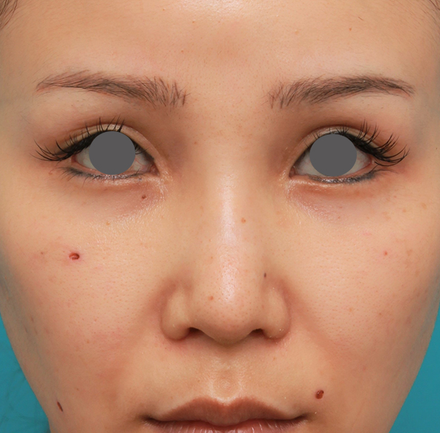 隆鼻術（シリコンプロテーゼ）,鼻のシリコンプロテーゼ+鼻先の耳介軟骨移植+小鼻縮小を同時に行った症例写真,6日後,mainpic_ryubi1055c.jpg