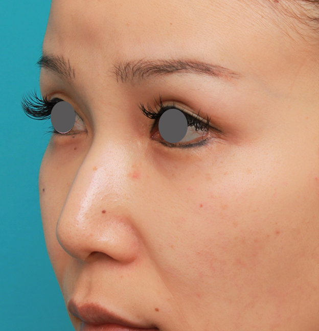 鼻翼縮小（小鼻縮小）,鼻のシリコンプロテーゼ+鼻先の耳介軟骨移植+小鼻縮小を同時に行った症例写真,手術前,mainpic_ryubi1055e.jpg