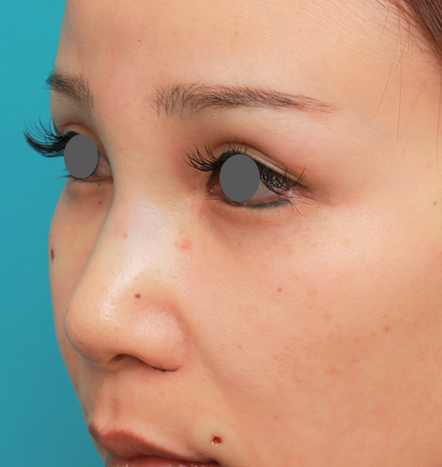 鼻翼縮小（小鼻縮小）,鼻のシリコンプロテーゼ+鼻先の耳介軟骨移植+小鼻縮小を同時に行った症例写真,手術直後,mainpic_ryubi1055f.jpg