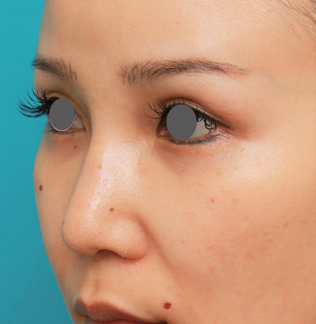 隆鼻術（シリコンプロテーゼ）,鼻のシリコンプロテーゼ+鼻先の耳介軟骨移植+小鼻縮小を同時に行った症例写真,6日後,mainpic_ryubi1055g.jpg