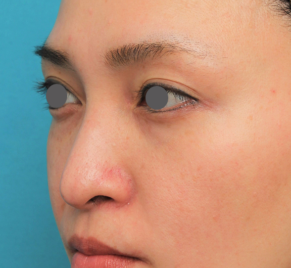 鼻翼縮小（小鼻縮小）,魔女鼻に対して垂れ鼻修正手術と小鼻縮小手術を同時に行った症例写真,After（6ヶ月後）,ba_tarebana001_b02.jpg