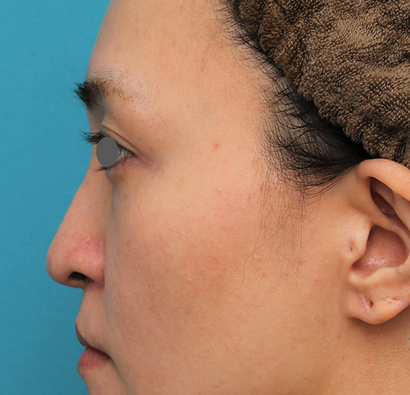 鼻翼縮小（小鼻縮小）,魔女鼻に対して垂れ鼻修正手術と小鼻縮小手術を同時に行った症例写真,After（6ヶ月後）,ba_tarebana001_b03.jpg