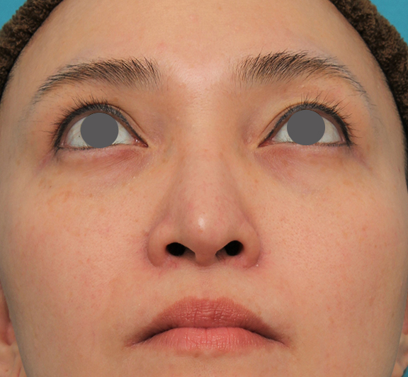 鼻翼縮小（小鼻縮小）,魔女鼻に対して垂れ鼻修正手術と小鼻縮小手術を同時に行った症例写真,After（6ヶ月後）,ba_tarebana001_b04.jpg