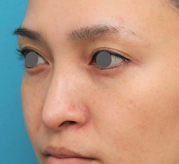 鼻翼縮小（小鼻縮小）,魔女鼻に対して垂れ鼻修正手術と小鼻縮小手術を同時に行った症例写真,Before,ba_tarebana001_b02.jpg