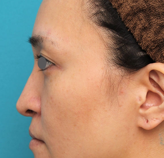 鼻翼縮小（小鼻縮小）,魔女鼻に対して垂れ鼻修正手術と小鼻縮小手術を同時に行った症例写真,Before,ba_tarebana001_b03.jpg