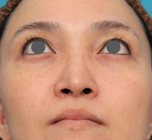 鼻翼縮小（小鼻縮小）,魔女鼻に対して垂れ鼻修正手術と小鼻縮小手術を同時に行った症例写真,Before,ba_tarebana001_b04.jpg