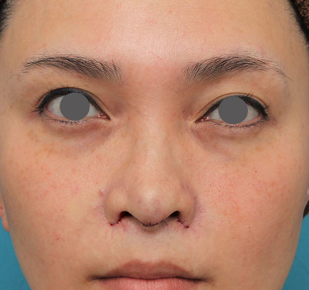 鼻翼縮小（小鼻縮小）,魔女鼻に対して垂れ鼻修正手術と小鼻縮小手術を同時に行った症例写真,手術直後,mainpic_tarebana001b.jpg